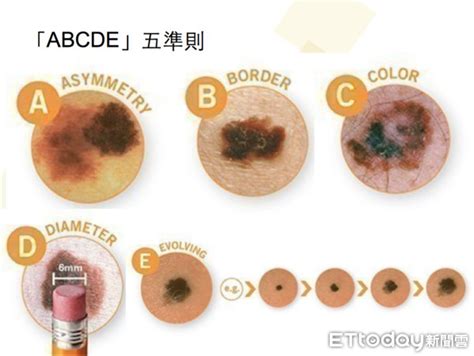 多痣體質|皮膚長痣、長斑是皮膚癌前兆？皮膚癌初期4大症狀快。